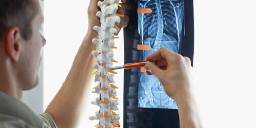 Most Common Spine Injuries from Car Accidents
